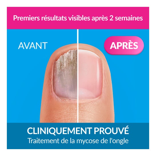 Excilor Mycose Des Ongles Solution 3,3ml