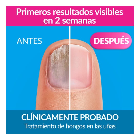 Excilor Solution XL Traitement Mycose de l'Ongle 7ml