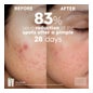 Martiderm Acniover Cicavent Anti-imperfecciones 40ml